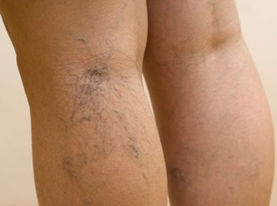 3 alimentos que te ayudarán a mejorar la circulación de las piernas