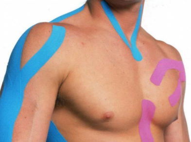 Beneficios del Kinesiotaping o vendaje neuromuscular