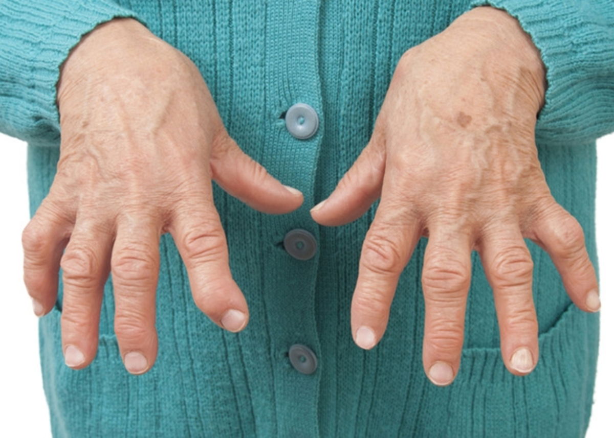 manos-con-artritis