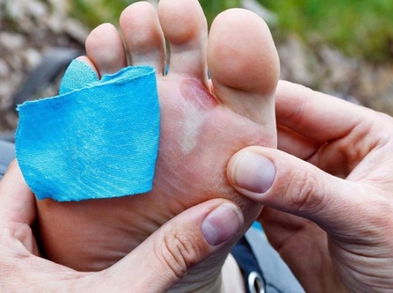 Consejos para evitar rozaduras y ampollas tras el ejercicio