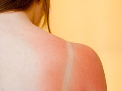 Remedios naturales para las quemaduras por golpes de calor