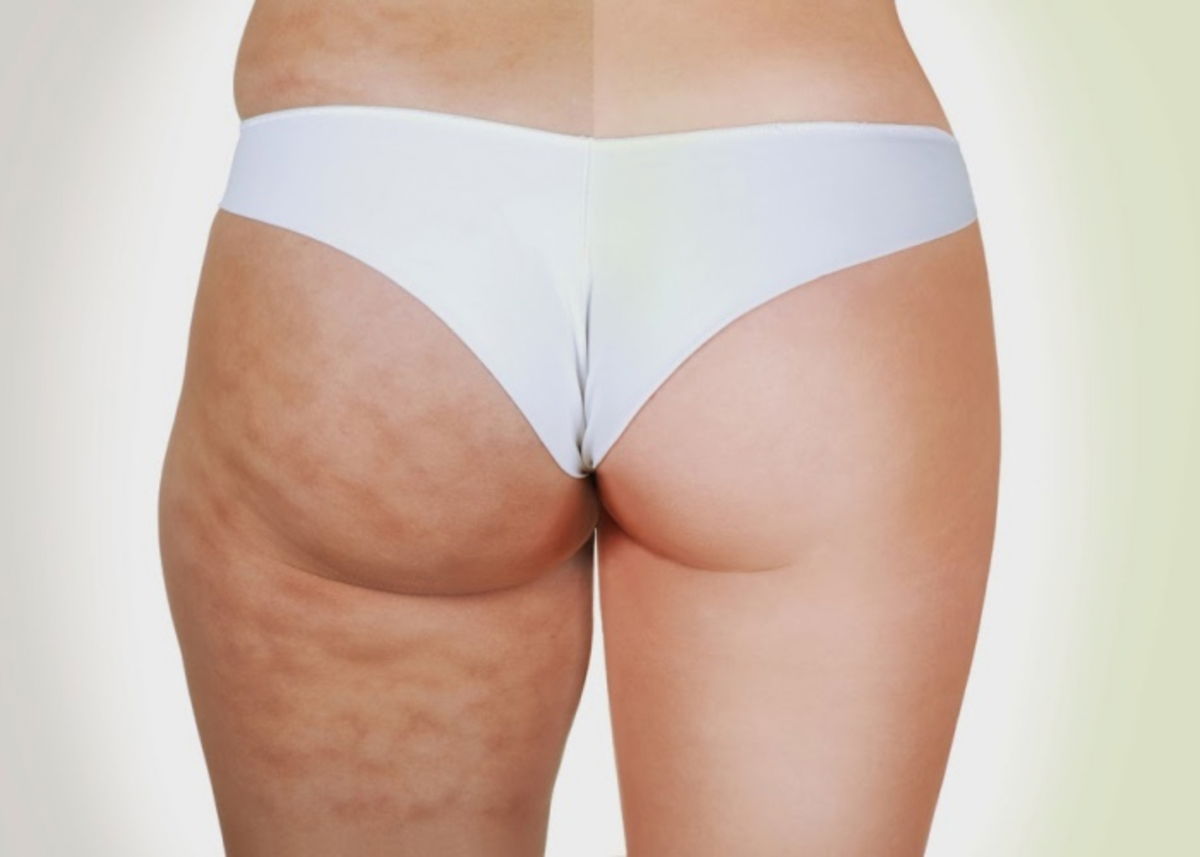 Persona celulitis