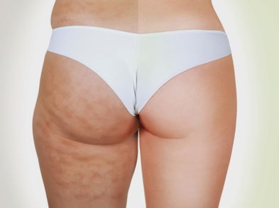 Dale la vuelta a la celulitis con estas bebidas naturales