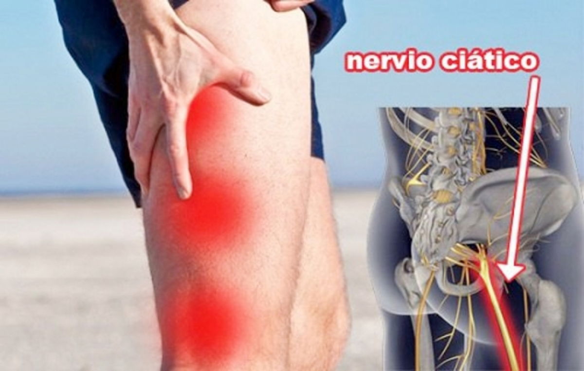 Pinzamiento en nervio ciático