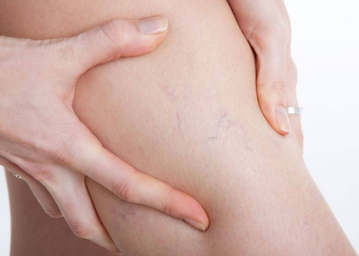 Varices