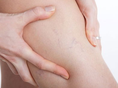 Consejos simples para desvanecer las varices