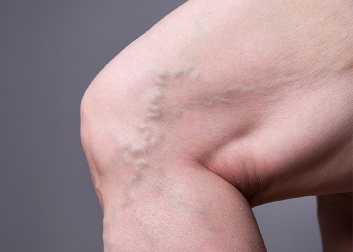 6 ejercicios para aliviar las varices