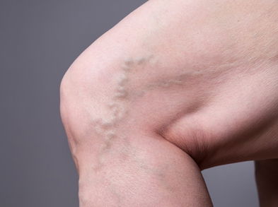6 ejercicios para aliviar las varices