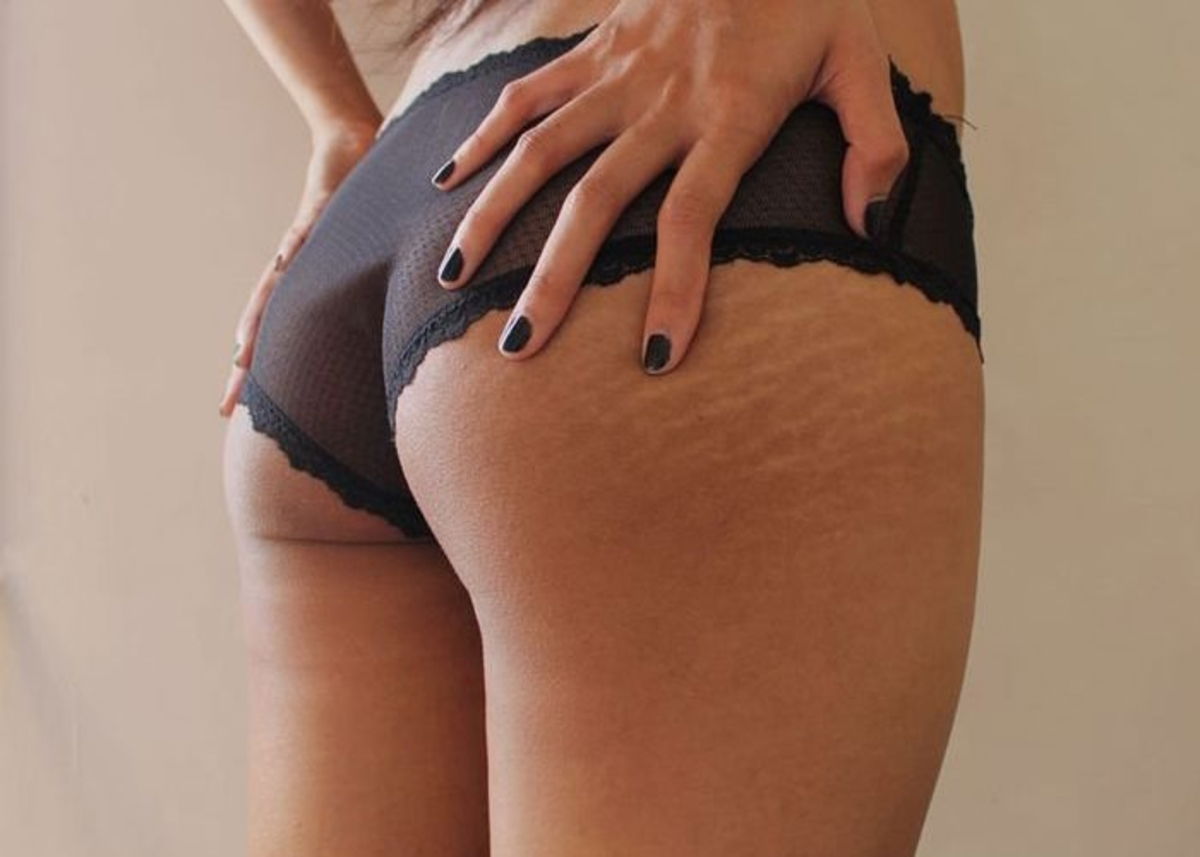 Glúteos con estrías