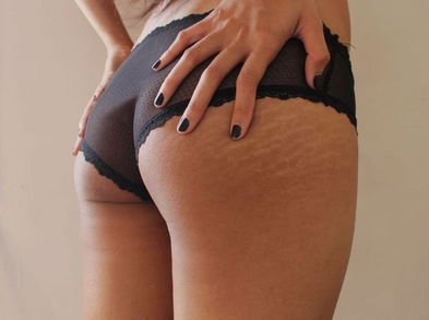 Minimiza las estrías con estas alternativas saludables