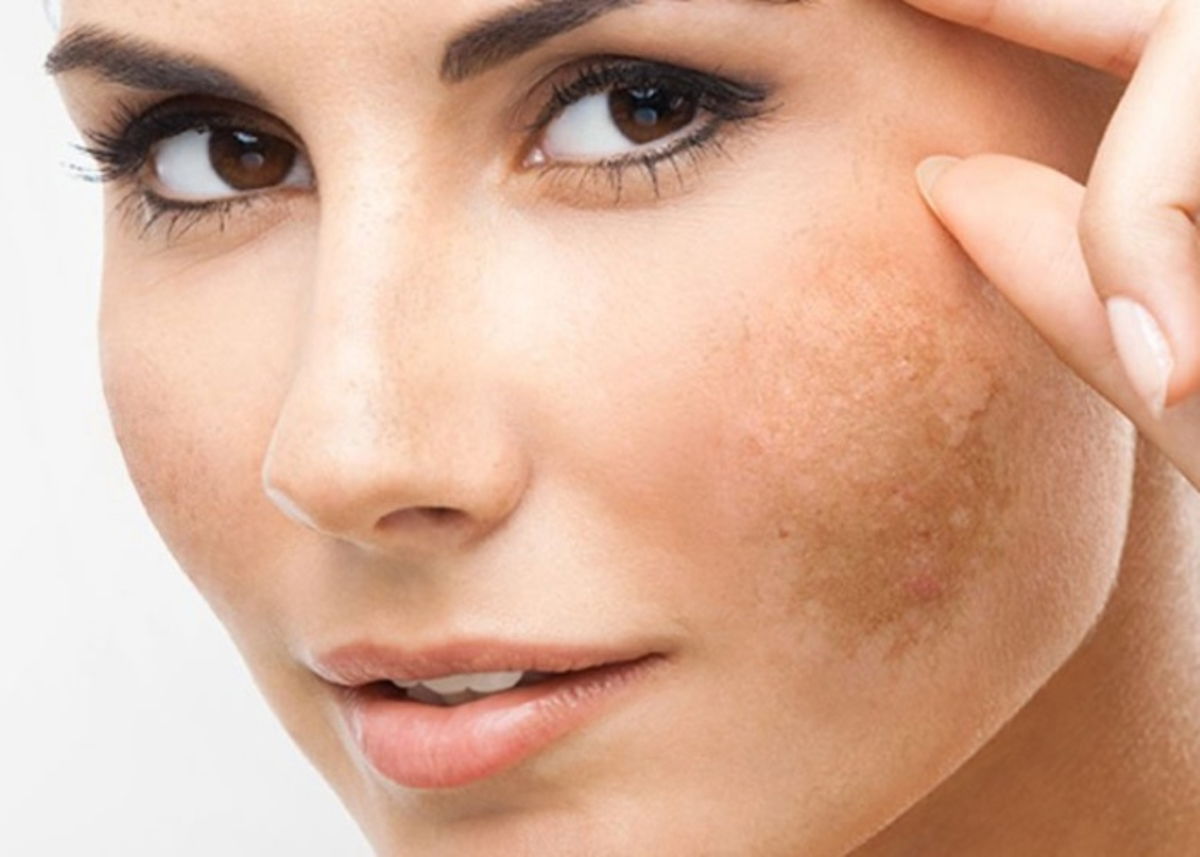 Mujer con manchas