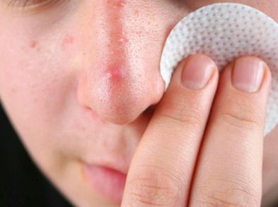 Tratamientos naturales para acabar con los forúnculos