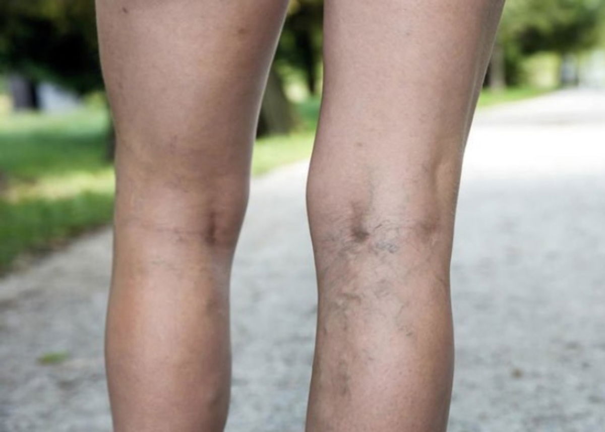 Piernas varices