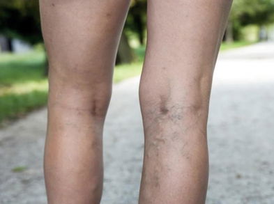 5 movimientos para piernas con varices