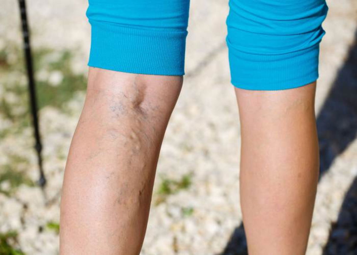 Persona con várices piernas