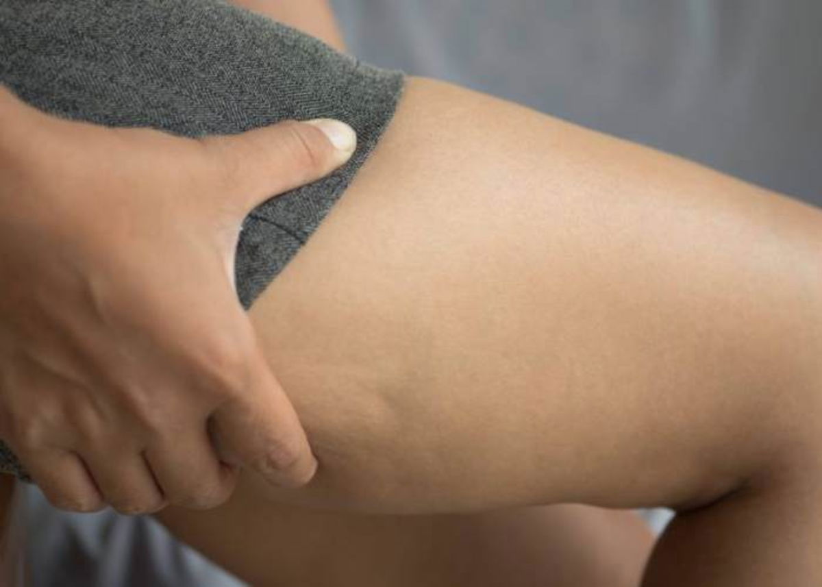 Pierna con celulitis