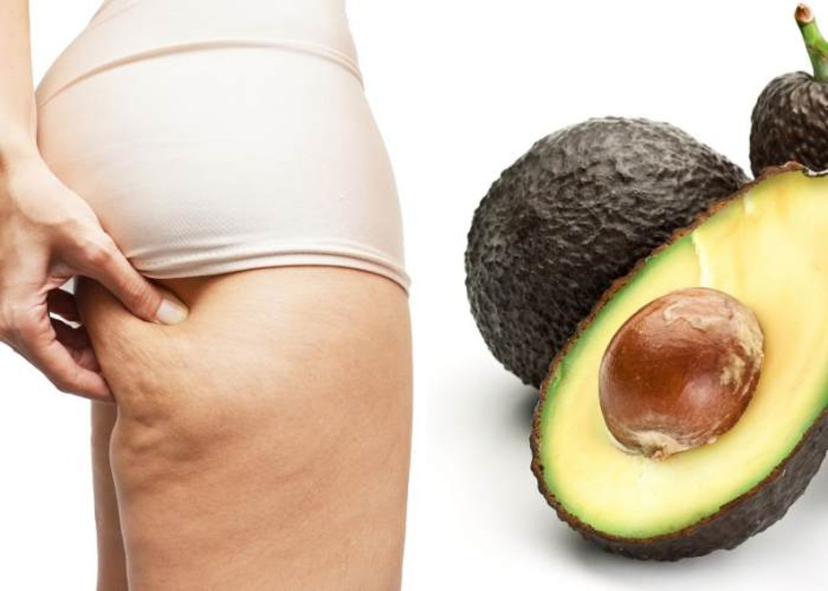 Celulitis y aguacate