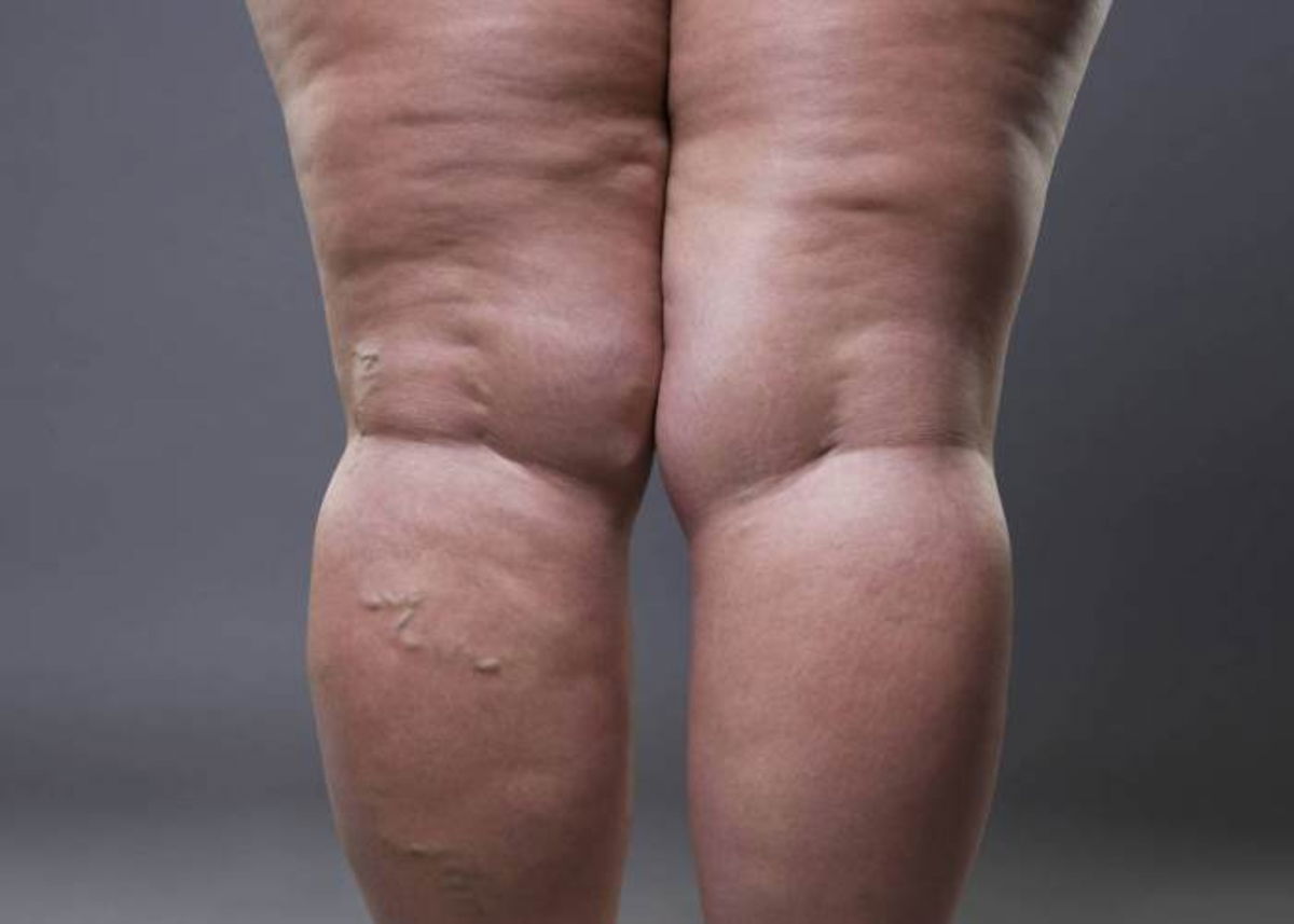 Persona piernas hinchadas