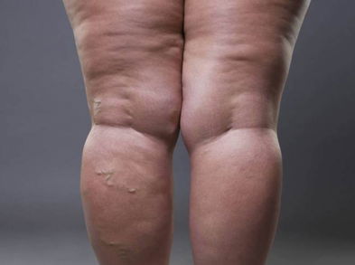 Reduce la retención de líquidos con estos consejos