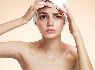 Alimentos que se relacionan con la aparición de granos en la piel