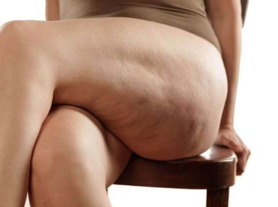 Elimina la celulitis con estas alternativas caseras