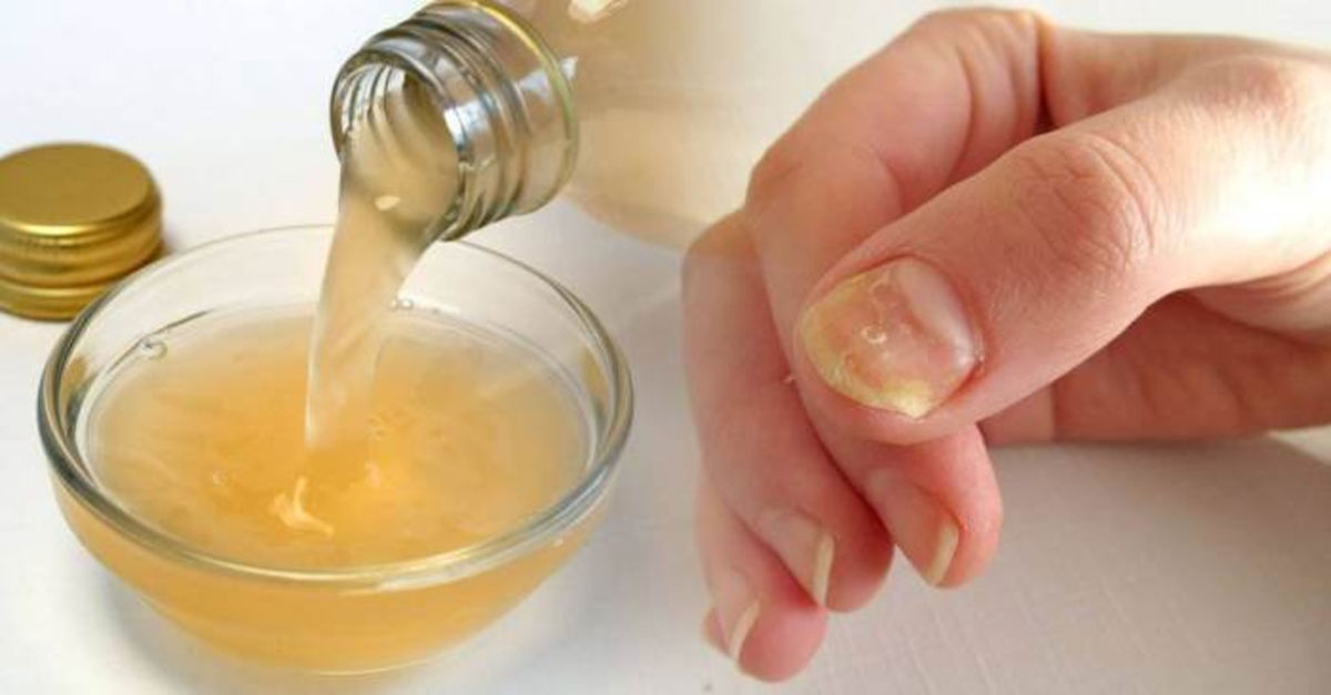 Tratamiento uñas hongos