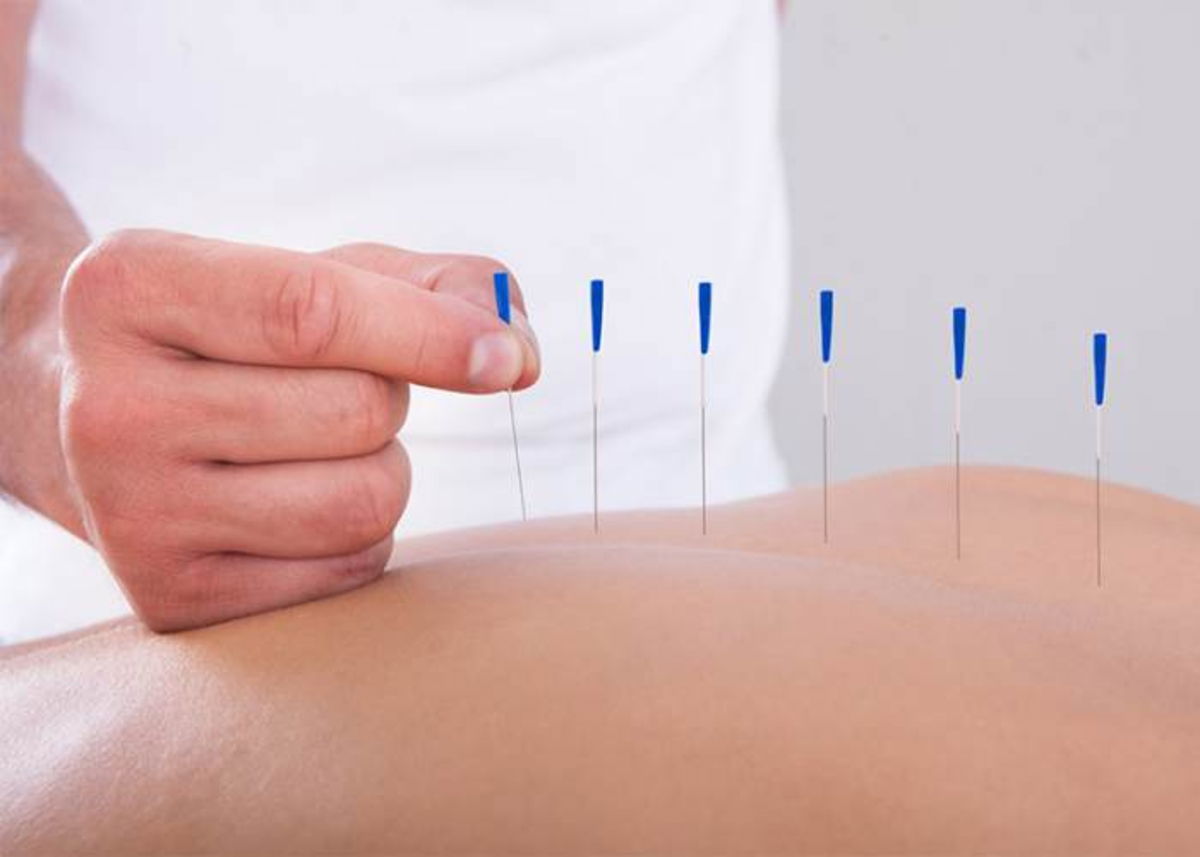 Especialista colocando agujas acupuntura