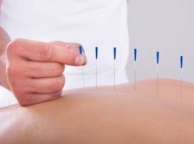 La acupuntura puede ayudar a tratar el dolor articular