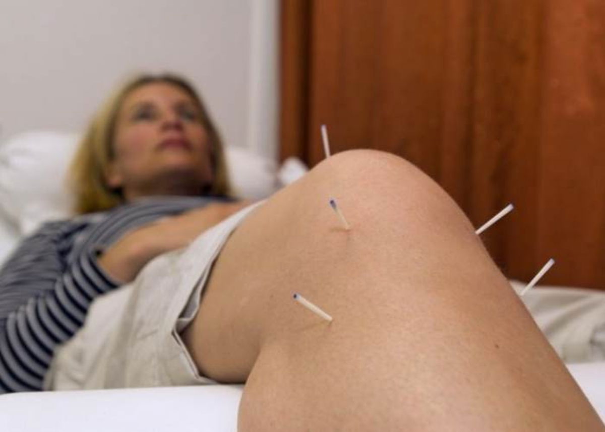 Mujer agujas de acupuntura en rodilla