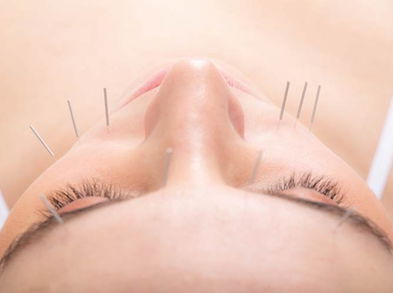 Acupuntura estética, una alternativa para la piel
