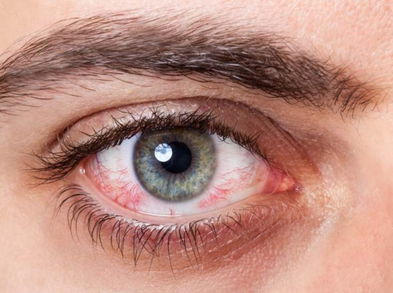 Alternativas naturales para aliviar el ojo rojo