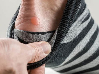 Alivia las rozaduras de los pies con estos remedios naturales
