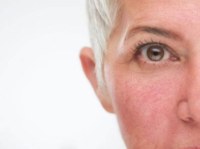 Elimina las rojeces de la cara con estos remedios caseros