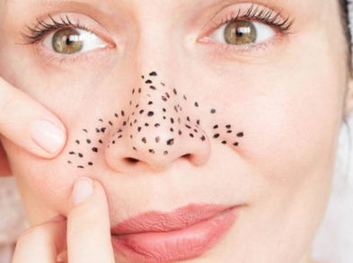 Motivos por lo que debes evitar apretar los puntos negros