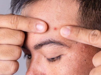 Por qué salen granos en la frente y cómo acabar con ellos