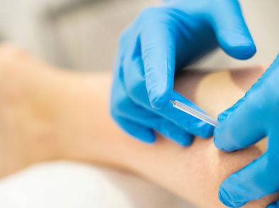 Punción seca: el secreto para la prevención y el tratamiento de lesiones deportivas