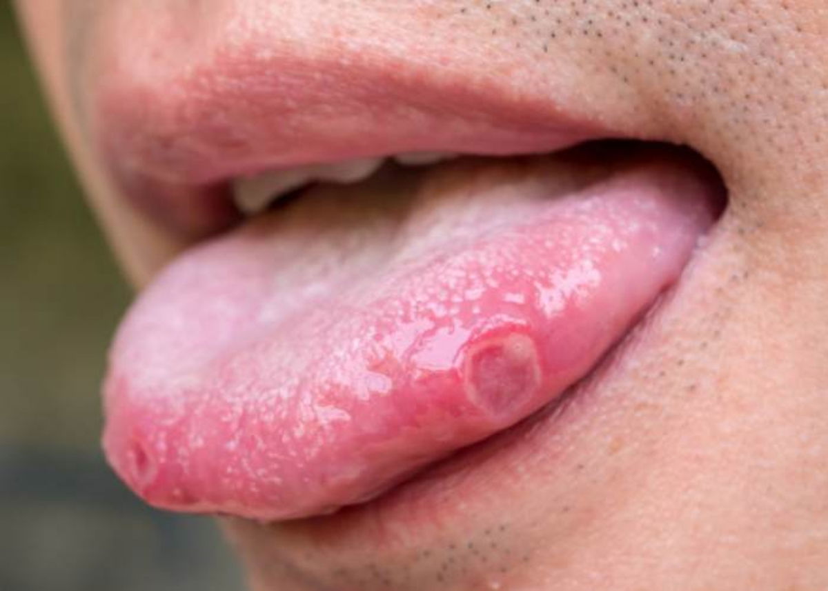 Personas con lesiones bucales