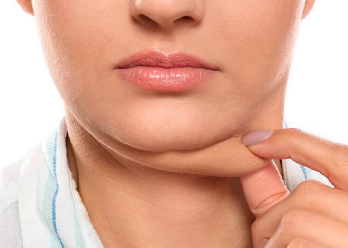 Persona con flacidez cuello