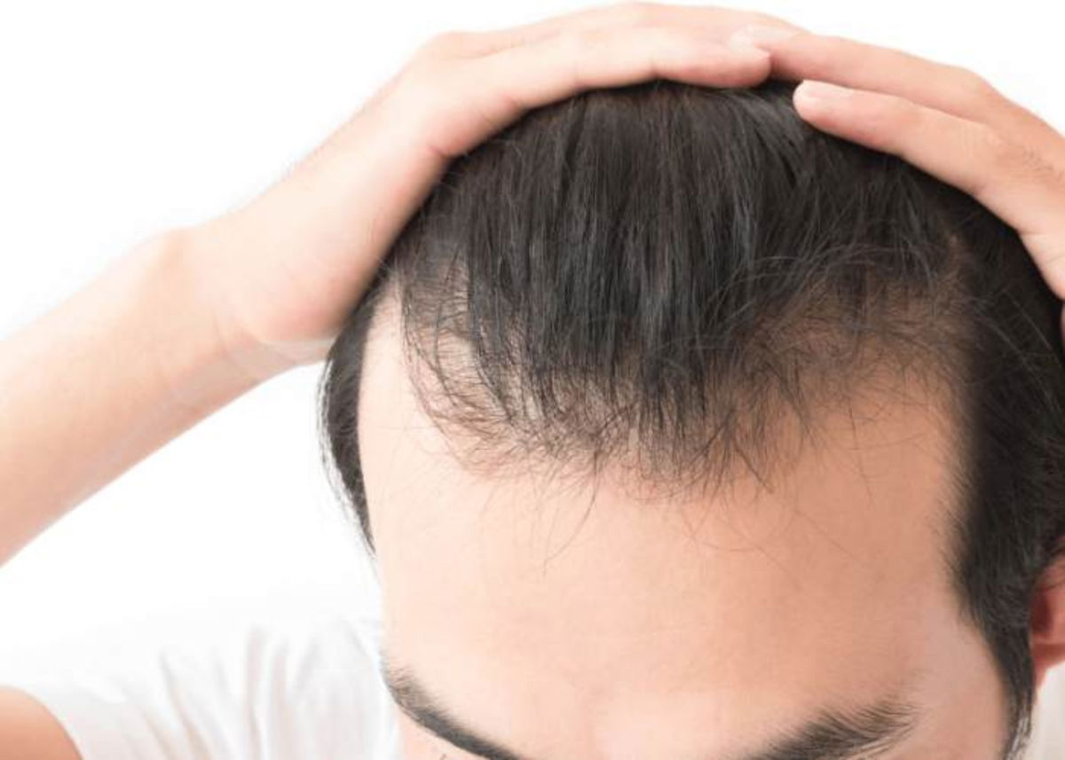 Caída de cabello