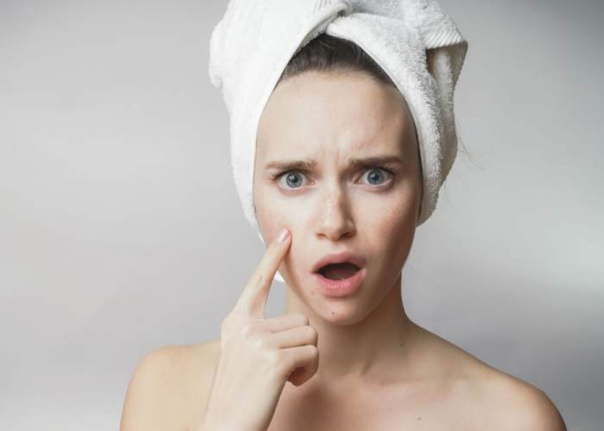 Mujer con acné