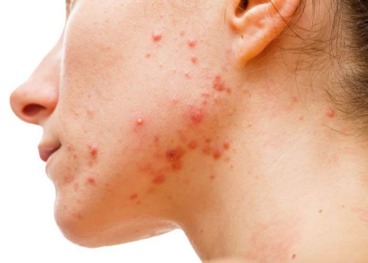 Rostro con cicatrices de acné