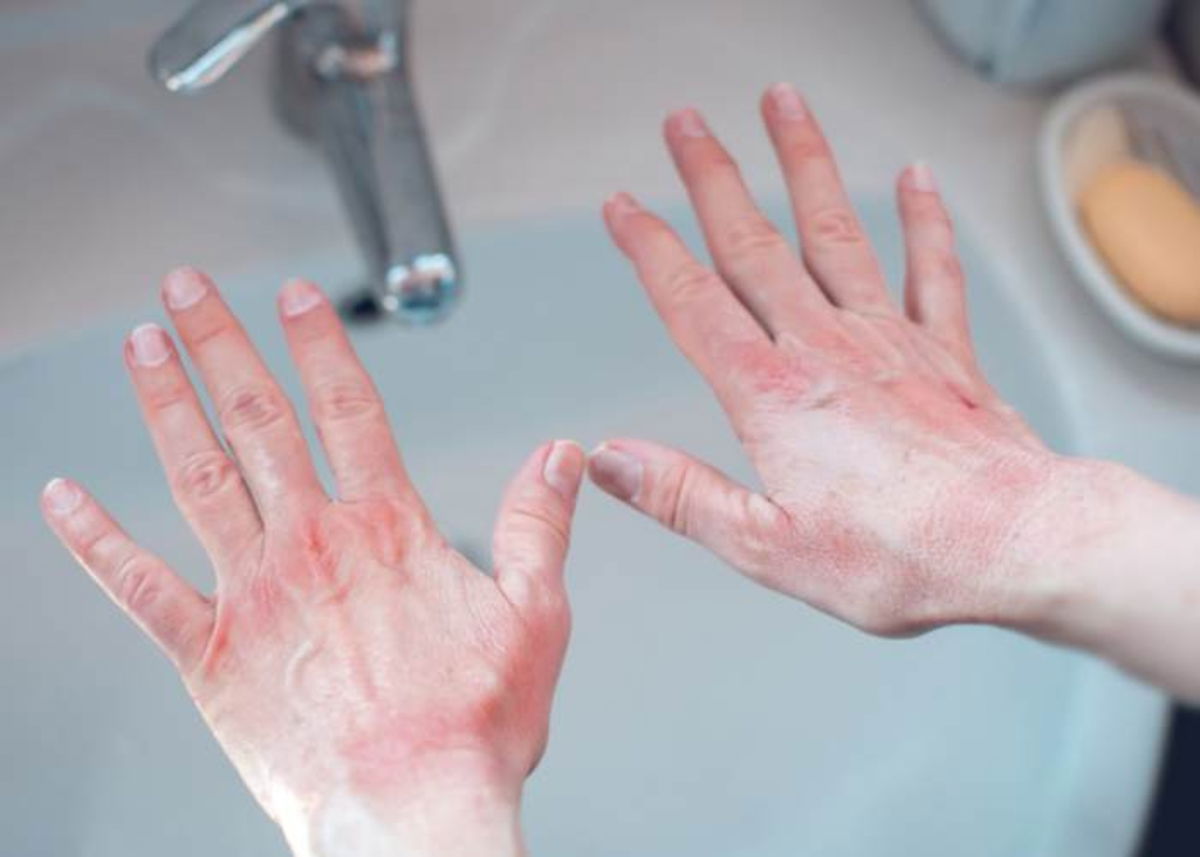 Manos con sabañones