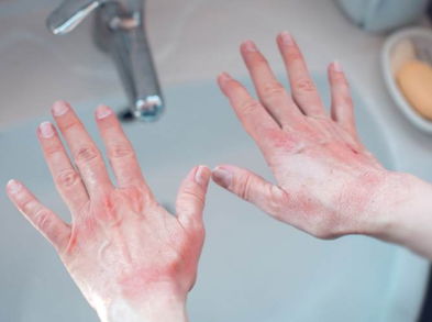 Qué es y cómo tratar los sabañones