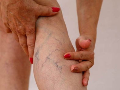 Calma el dolor de várices con estos remedios naturales