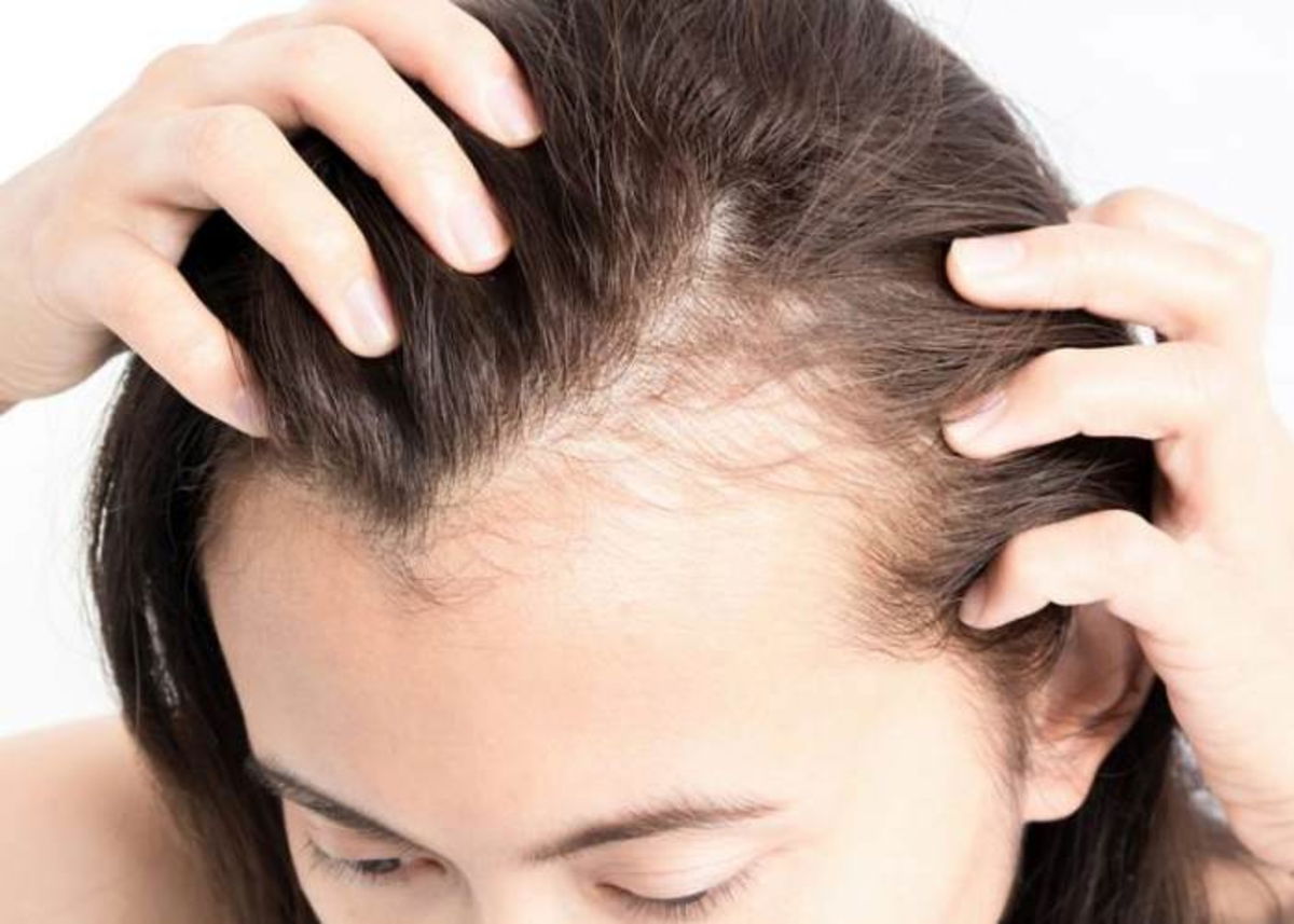 Persona con calvicie