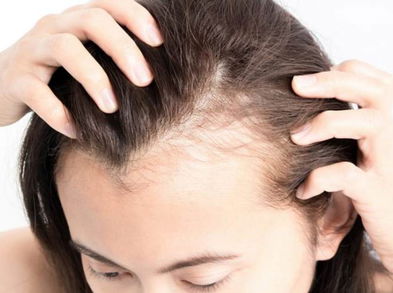 ¿Cómo prevenir la calvicie de manera natural?