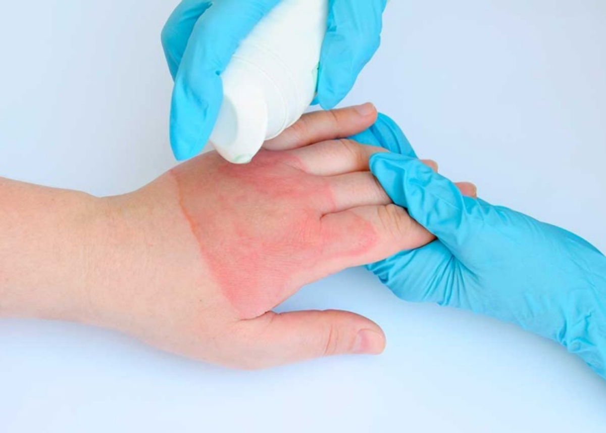 Remedio sobre piel quemada