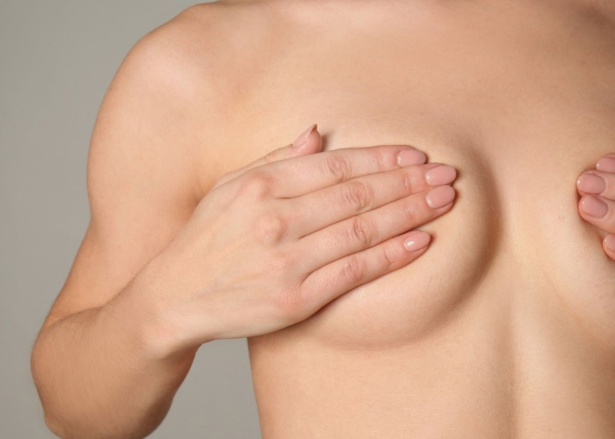 Estrías en pechos