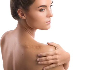 Remedios naturales para eliminar viejas cicatrices