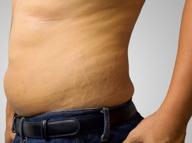 ¿Cómo reducir las estrías en hombres?